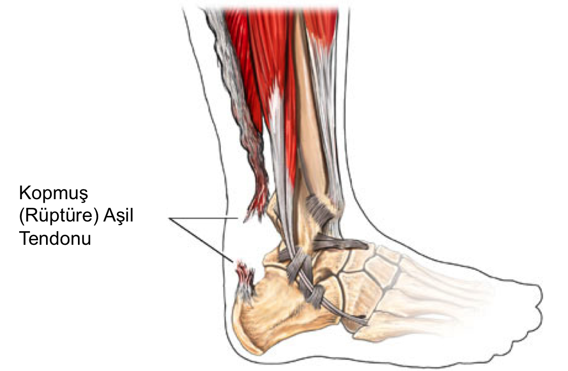Aşil tendonu kopması nasıl olur ?